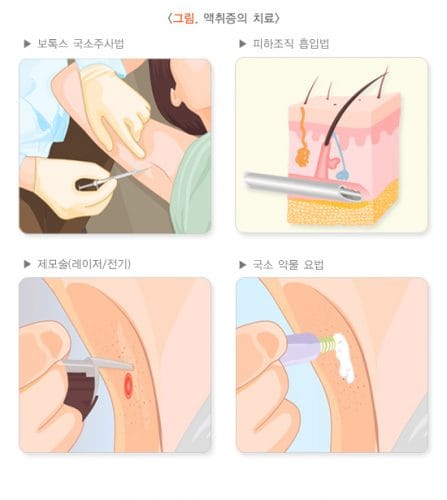 액취증, 고민 끝! 원인부터 치료, 사후관리 3 액취증의 치료