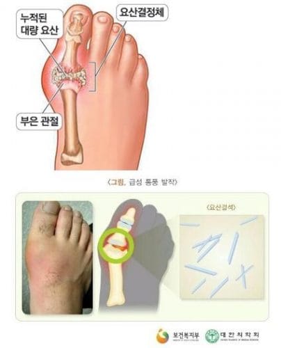 발가락이 찢어질 듯 아파요! 통풍, 완벽 정복 가이드! (원인부터 치료, 예방, 음식까지!) 2 통풍 발 사진