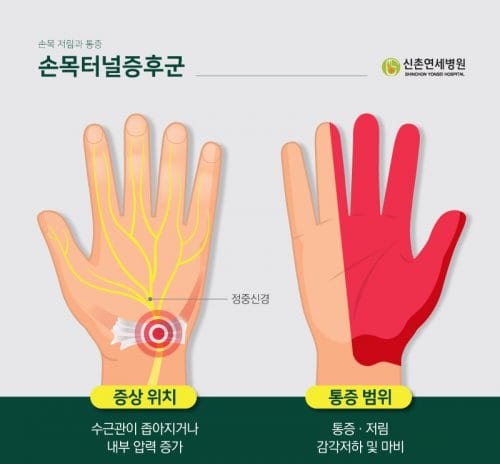 손목 터널 증후군, 진단부터 치료 & 예방까지 완벽 가이드! 2 손목터널증후군